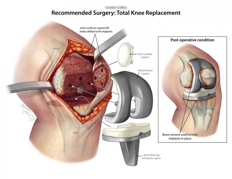 Knee replacement