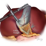 Laparoscopic Cholecystectomy