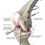 Knee arthroscopy & hardware removal