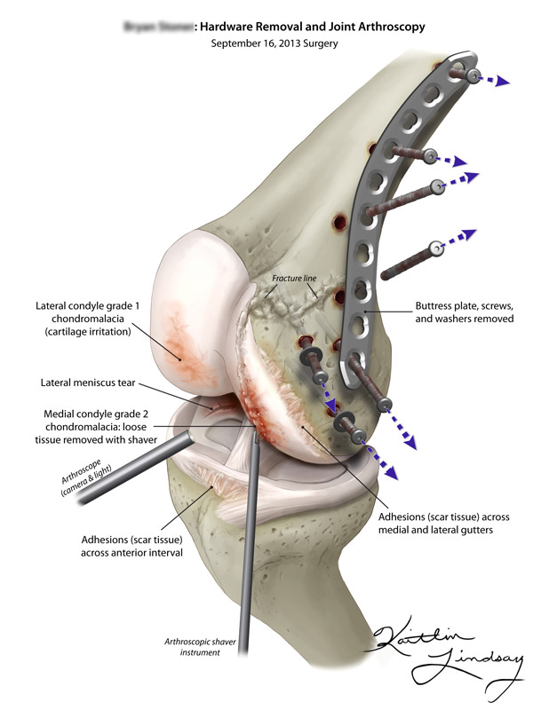 Knee arthroscopy & hardware removal