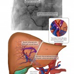Hepatic arterio-portal venous fistula
