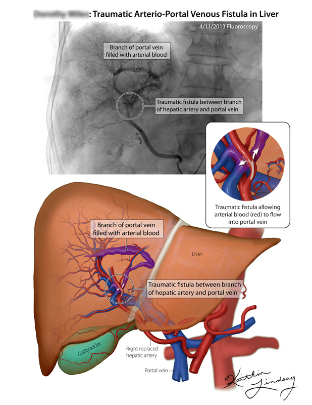 Hepatic arterio-portal venous fistula