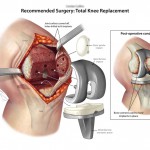 Knee replacement