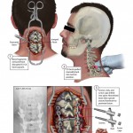 Posterior spinal fusion
