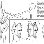 Patellar fracture fixation