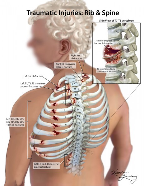Traumatic rib and spine injuries