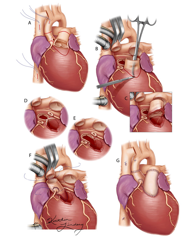 Ross-Konno heart procedure