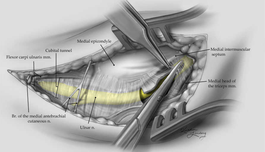 icd 10 code for left ulnar nerve decompression